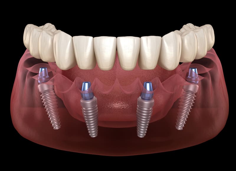 A 3D-rendered illustration of an All-on-4 dental implant system, showing four titanium implants anchored in the lower jaw to support a full-arch prosthetic dental bridge.