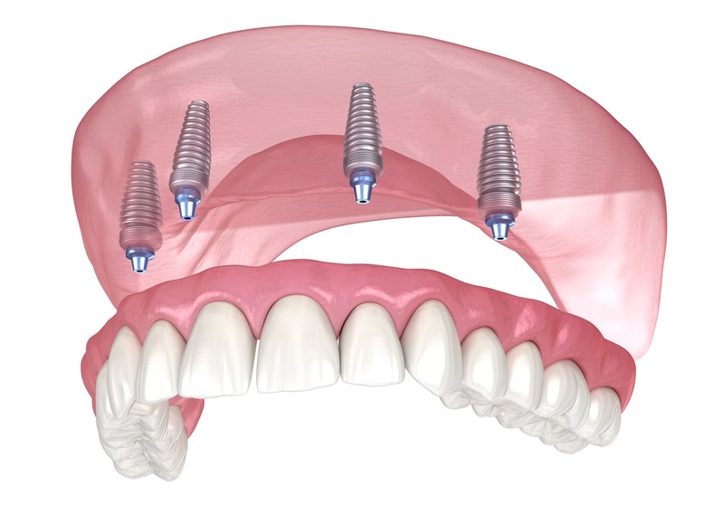 A 3D-rendered illustration of an All-on-4 dental implant system, showing four titanium implants embedded in the upper jawbone supporting a full-arch prosthetic denture for complete tooth replacement.