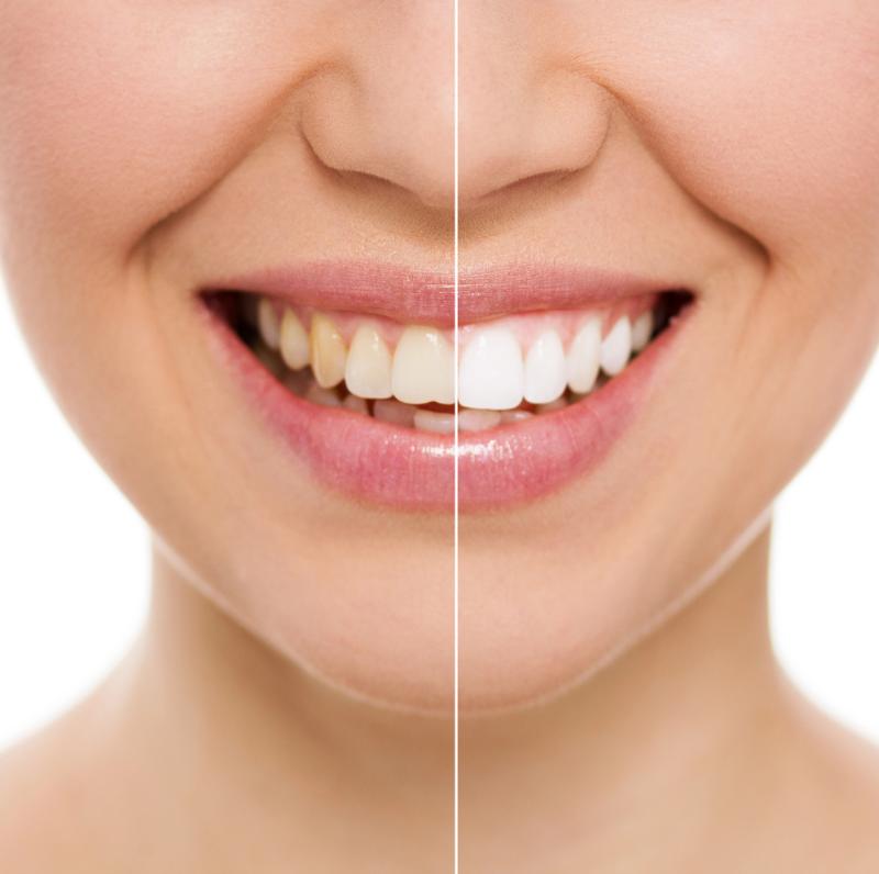 teeth whitening before after results