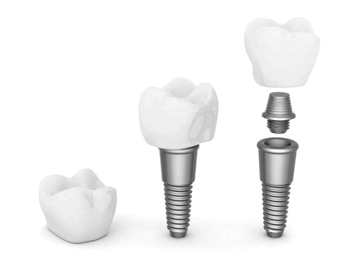 A 3D-rendered illustration of dental implants, showing the components of a titanium implant, abutment, and ceramic crown, demonstrating the structure and function of modern tooth replacement solutions.