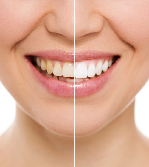 Teeth Whitening
