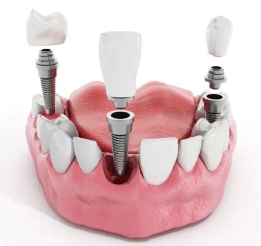 A 3D-rendered illustration of dental implants showing titanium screws placed in the jawbone with crowns being attached, demonstrating the process of dental restoration and tooth replacement.